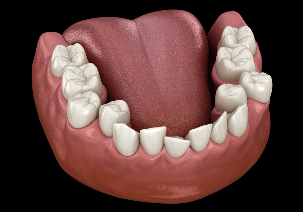 Correction of Crowded or Gapped Teeth