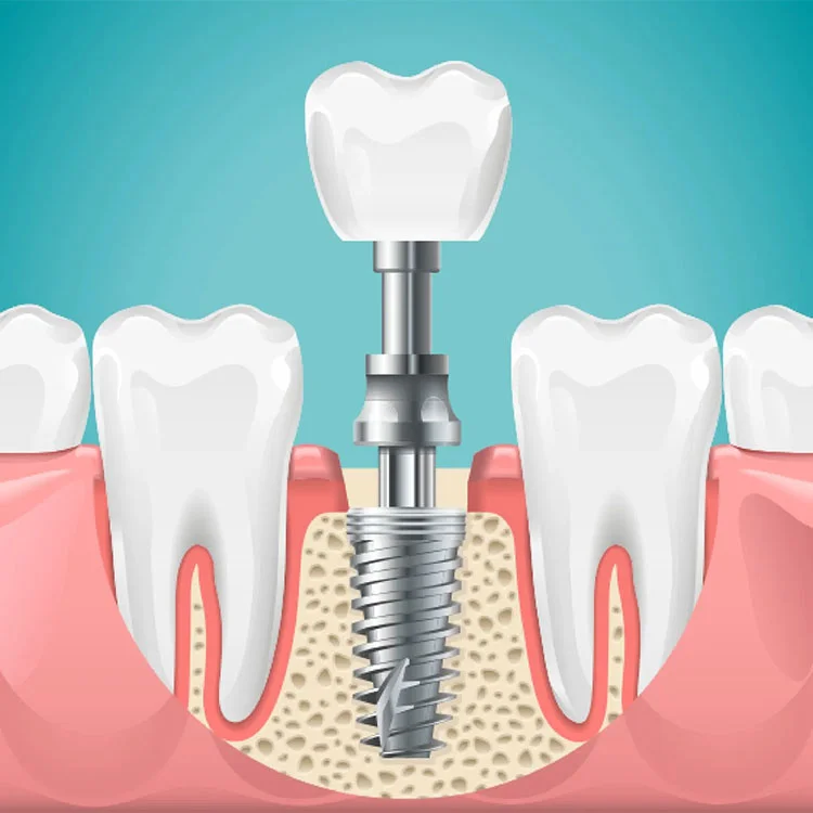 Dental Implants