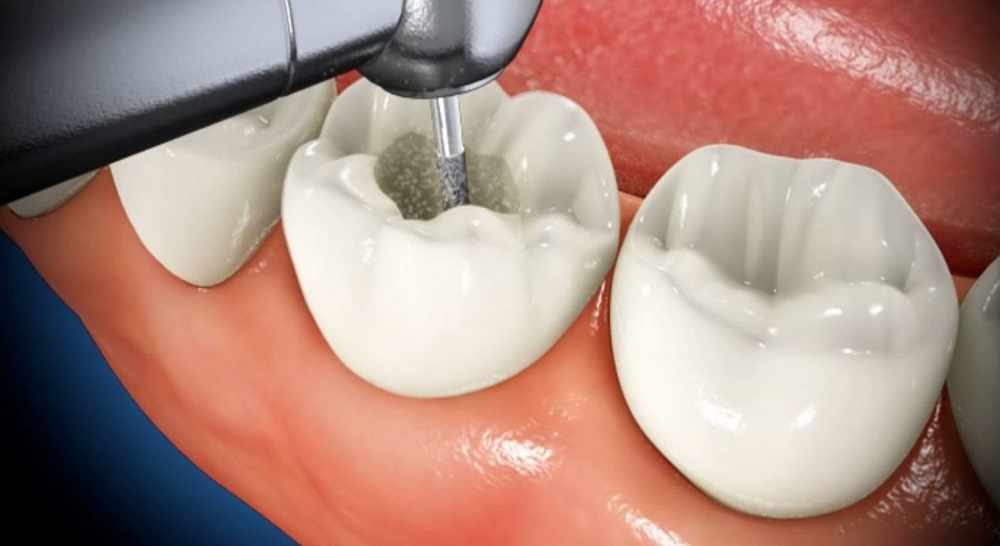 Fillings for Cavity