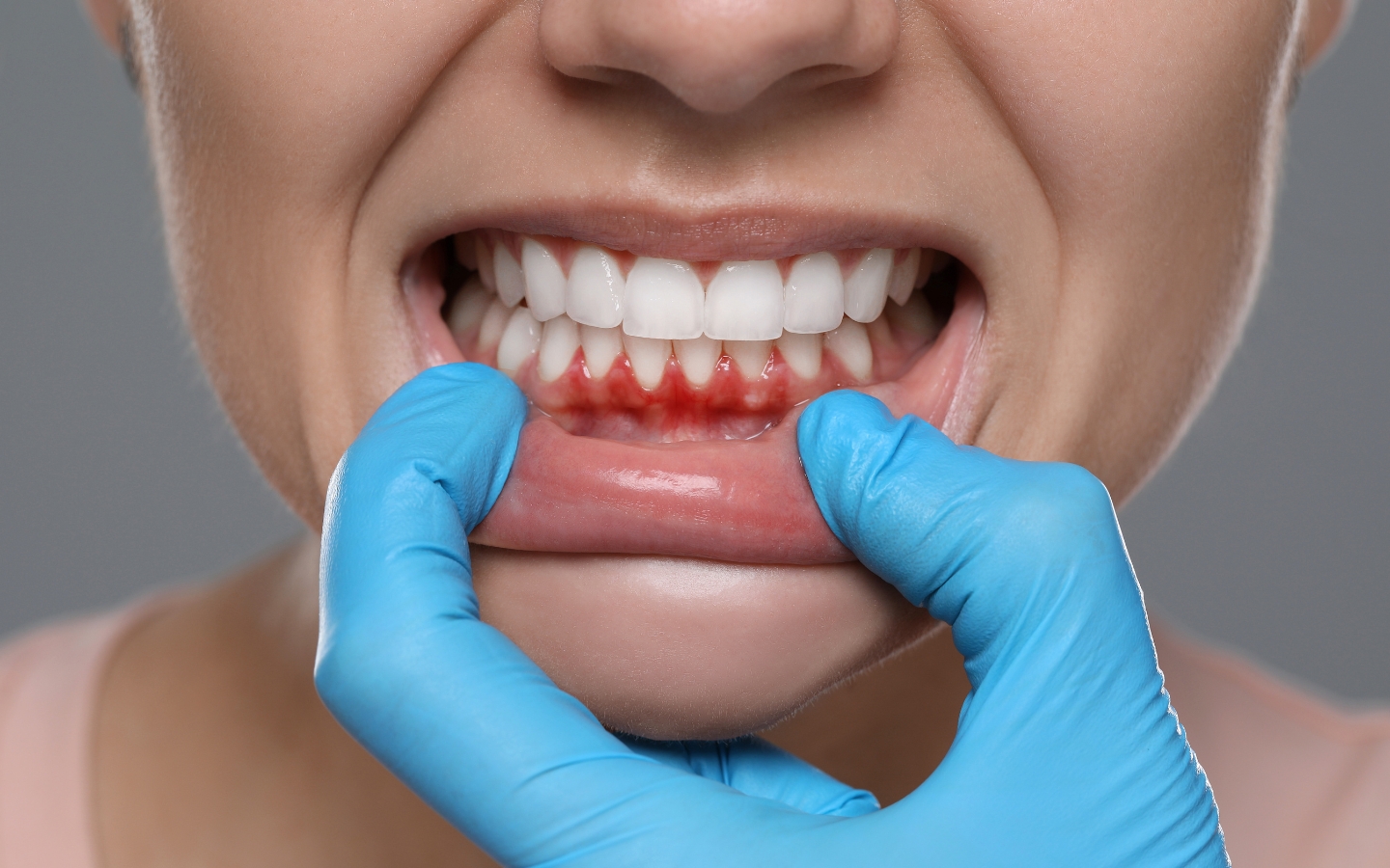 Gum Disease Treatments