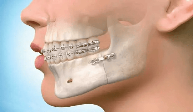 Jaw Treatment Therapy