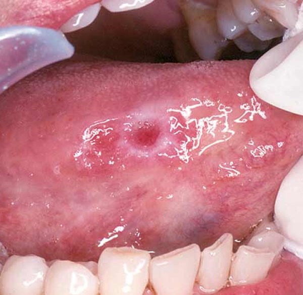 Oral Cancer Screening