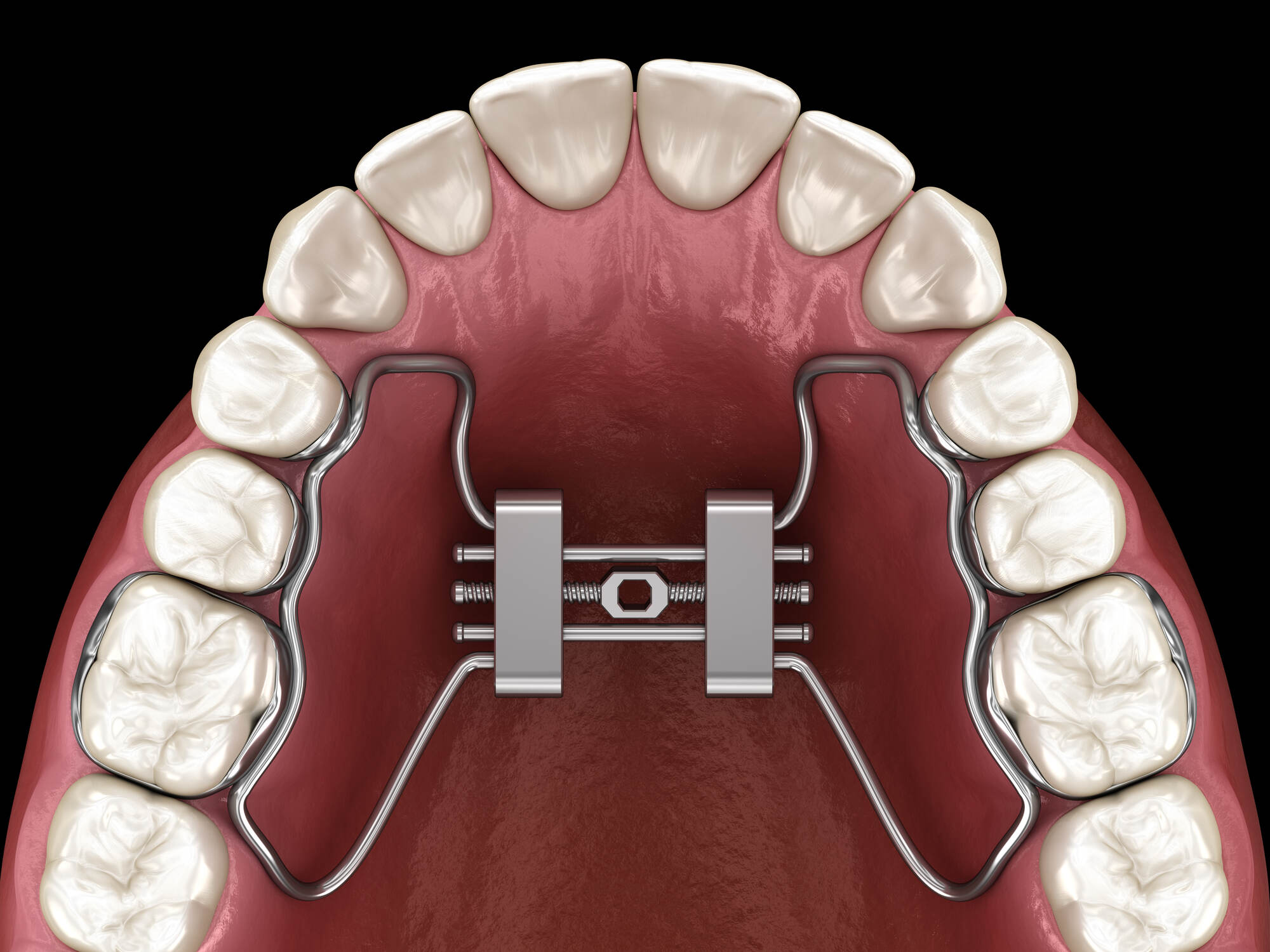Palatal Expander