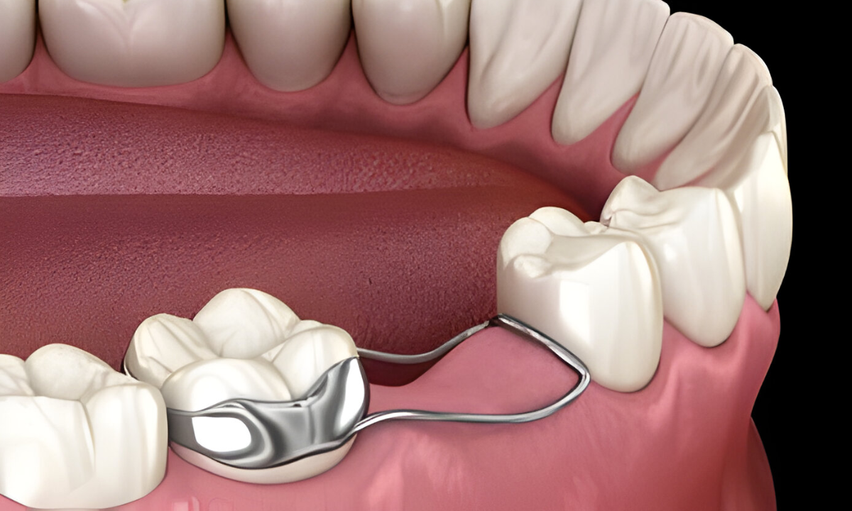 Space Maintainers for Children