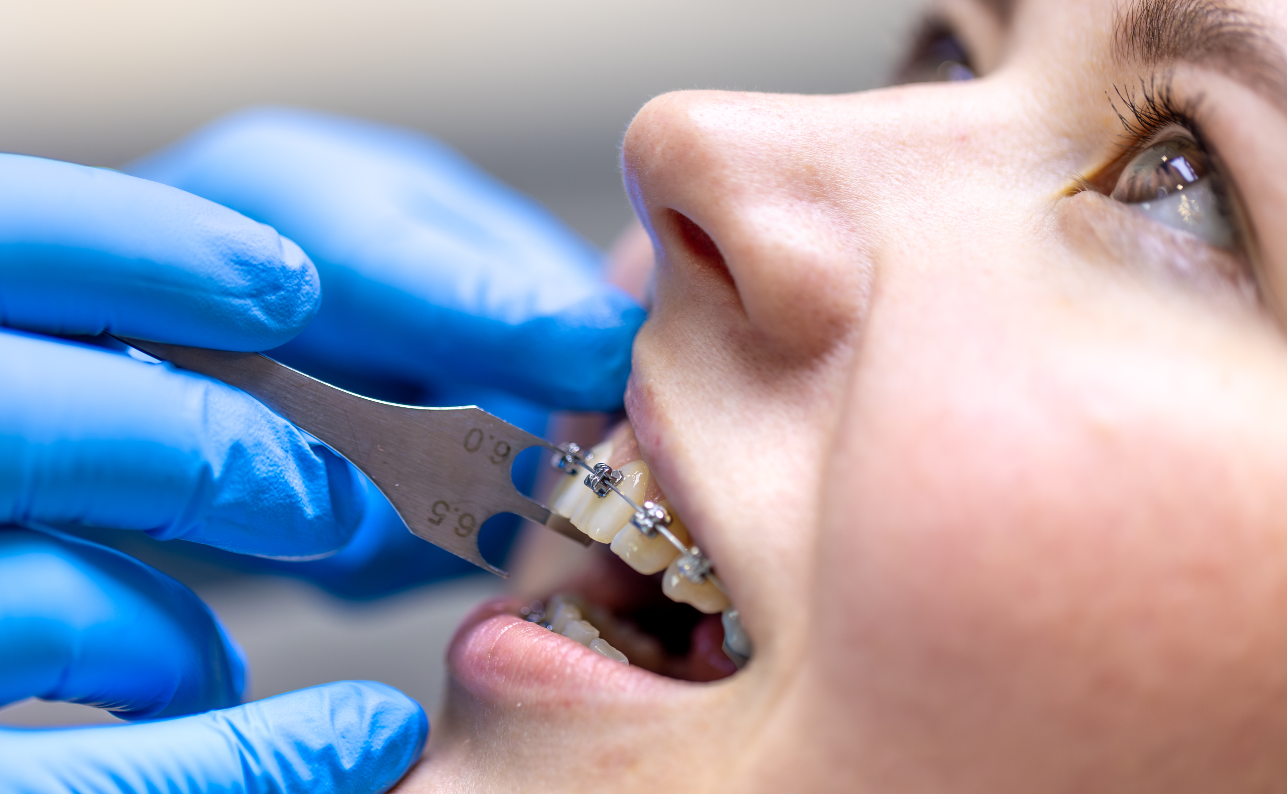 dental procedure installing braces close up dentistry braces teeth (1)